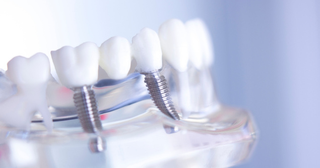 dental bridge aftercare tips for a smooth recovery in prairie village