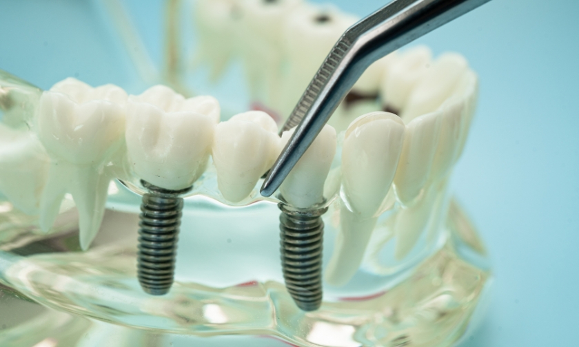 dental implants and technology