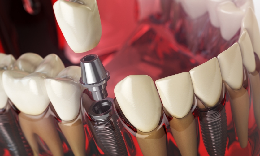dental implants reduce heart disease risk