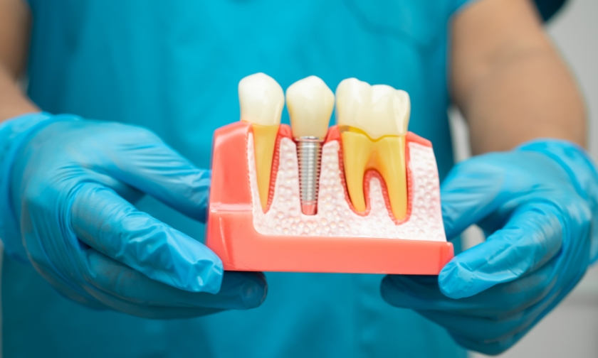 gen x and dental implants