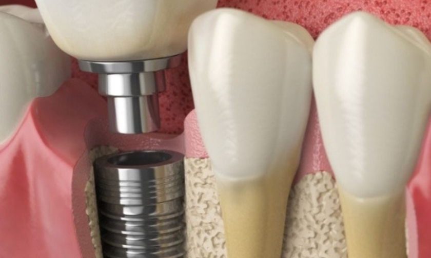 bone-strengthening protocols for dental implants