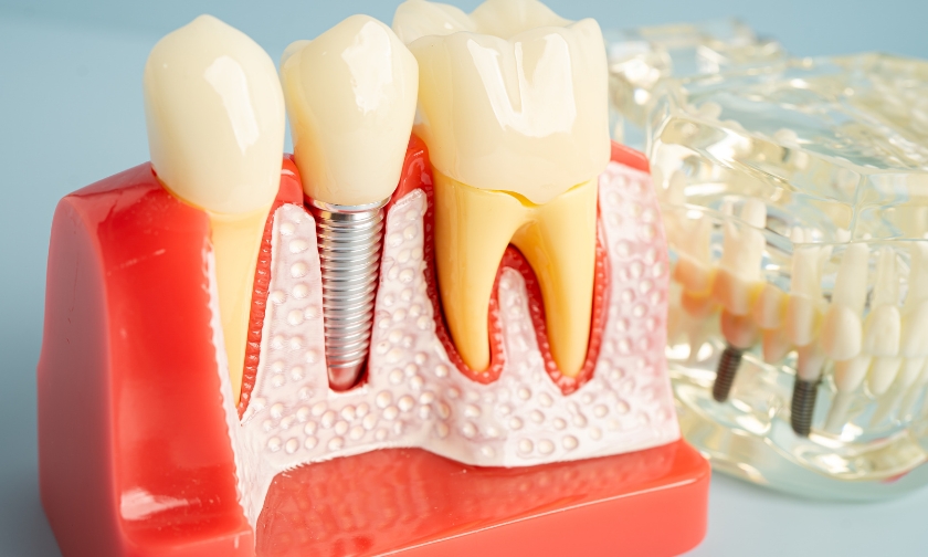 dental implants in Prairie Village