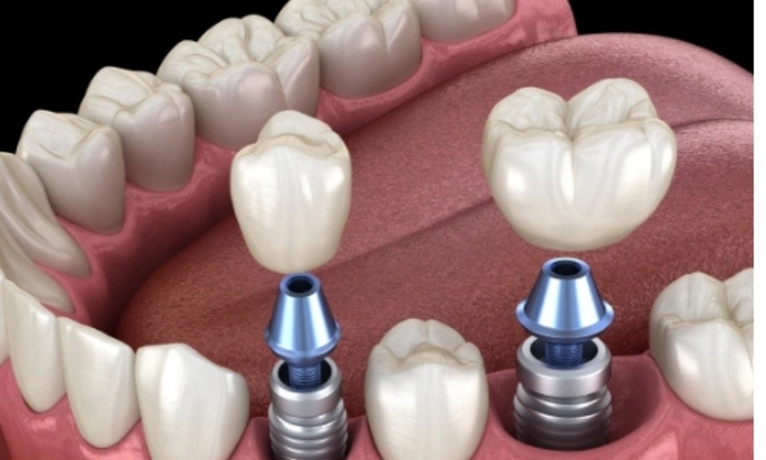Smoking and Vaping: Why “Clouds” Sink Dental Implants in 2026