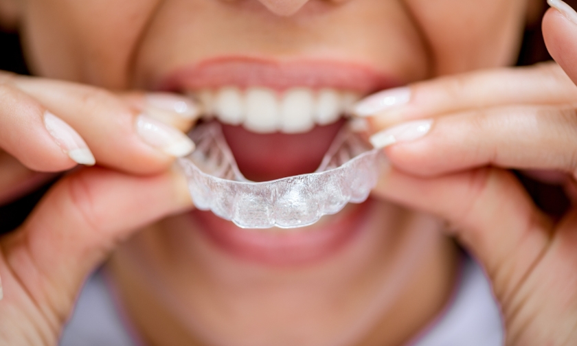 adult dental crowding with invisalign