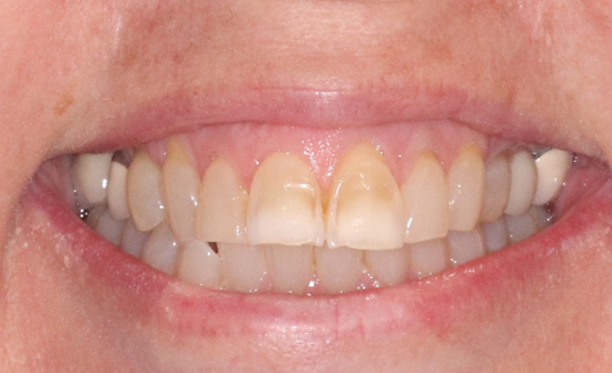 Dental Bridges Prairie Village | Monarch Dental Care
