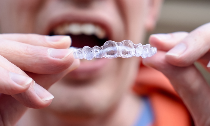 invisalign treatment for gum black triangles