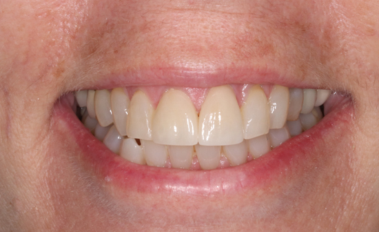 Teeth Cleaning in Leawood
